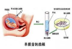 <b>在武汉，试管婴儿成功后是否需要进行羊膜穿刺？</b>
