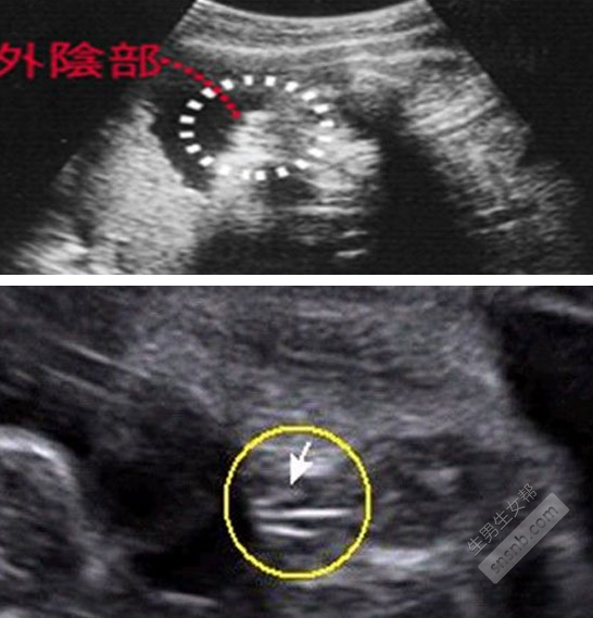 你需要做的第一件事是进行超声波扫描以确定胎儿的性别。[图]。