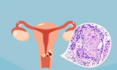 <b>湖州如何助孕公司：鳞状细胞癌如何影响怀孕，如何预防和治疗？</b>