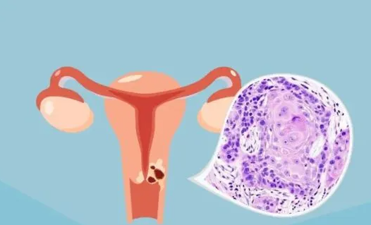 湖州如何助孕公司：鳞状细胞癌如何影响怀孕，如何预防和治疗？